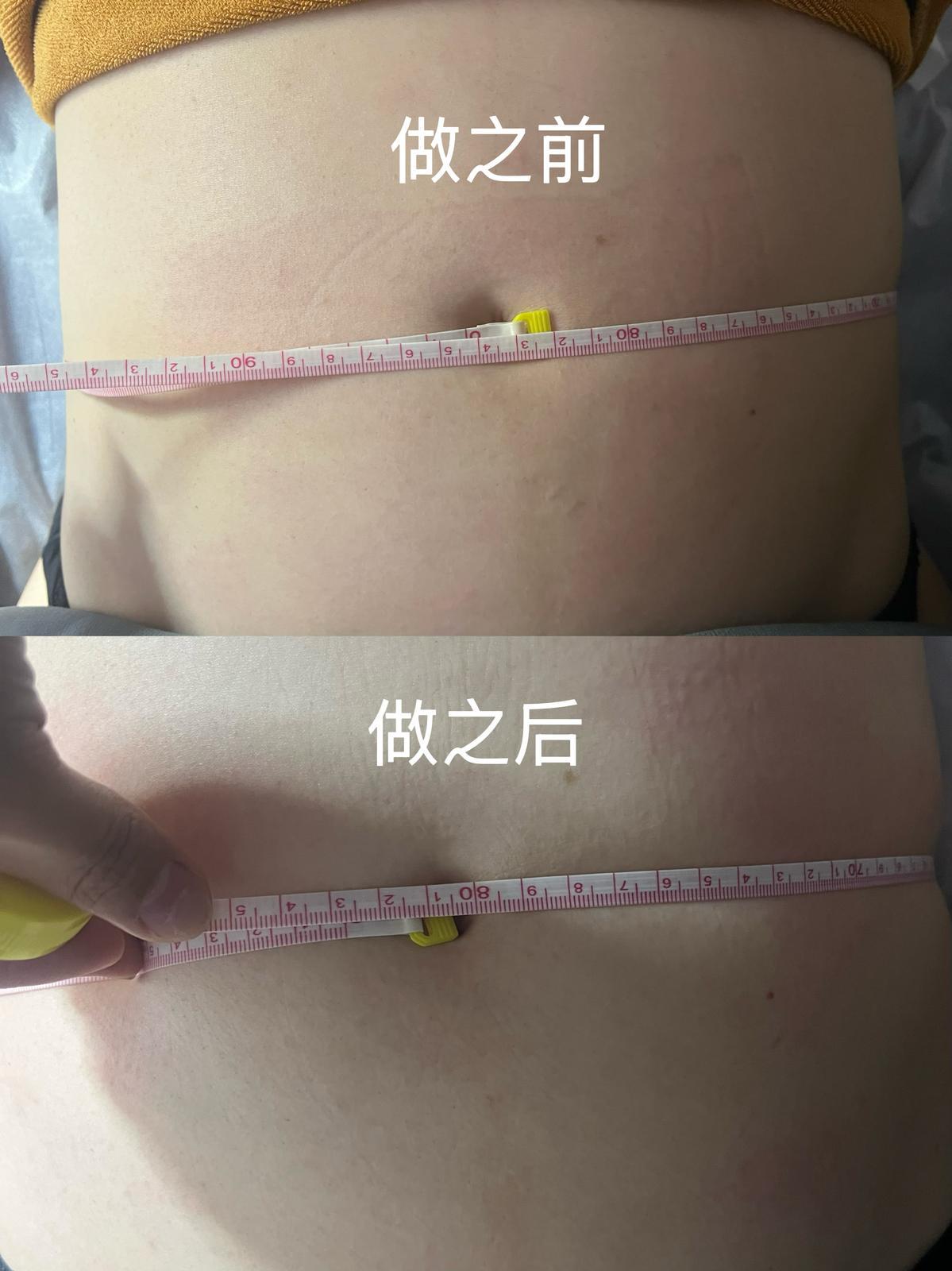 SKYE Aesthetics — Abdomen Contouring 03