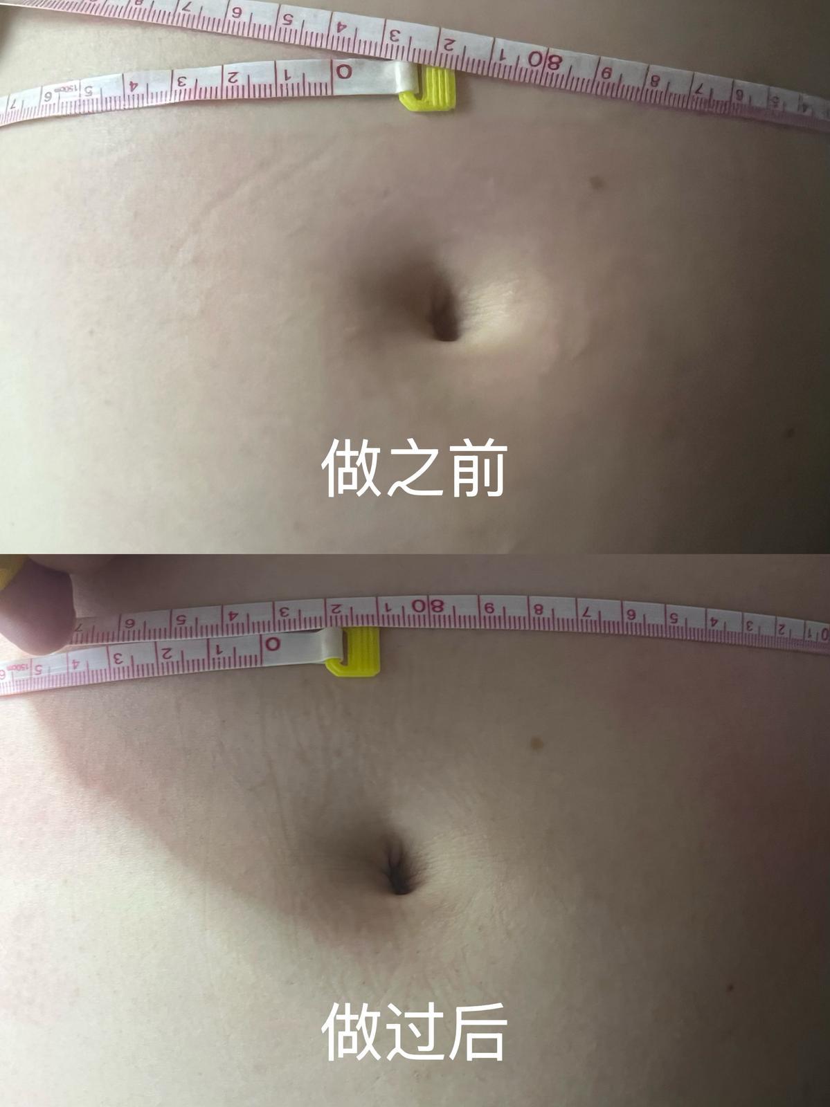 Before and after — Abdominal Care 02 | SKYE Aesthetics