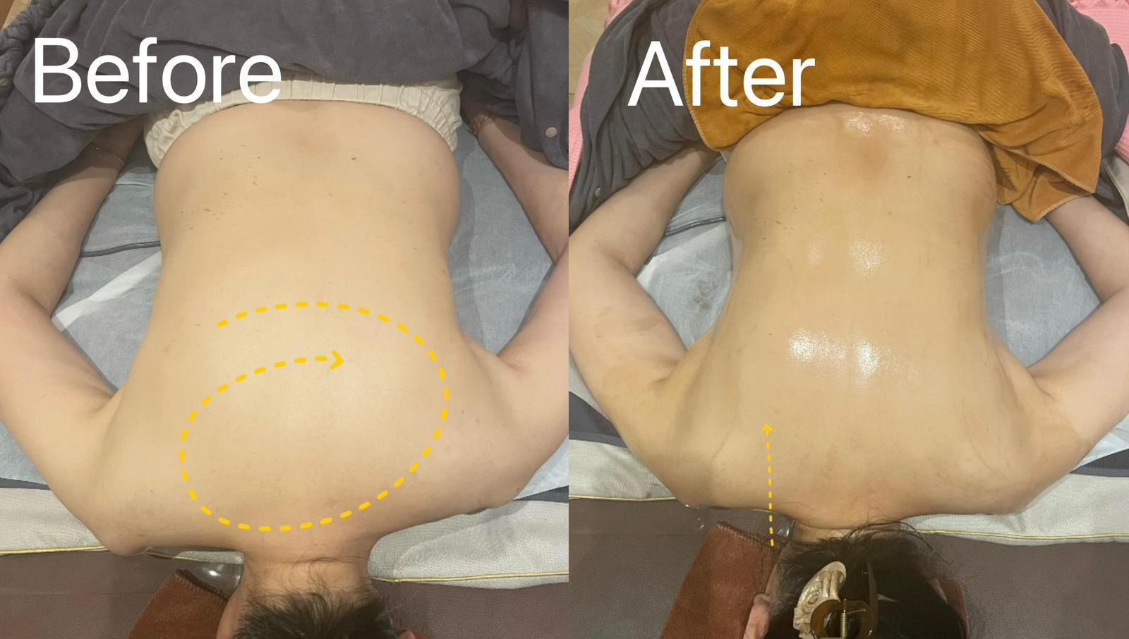Before and after — Back And Shoulder Care 02 | SKYE Aesthetics