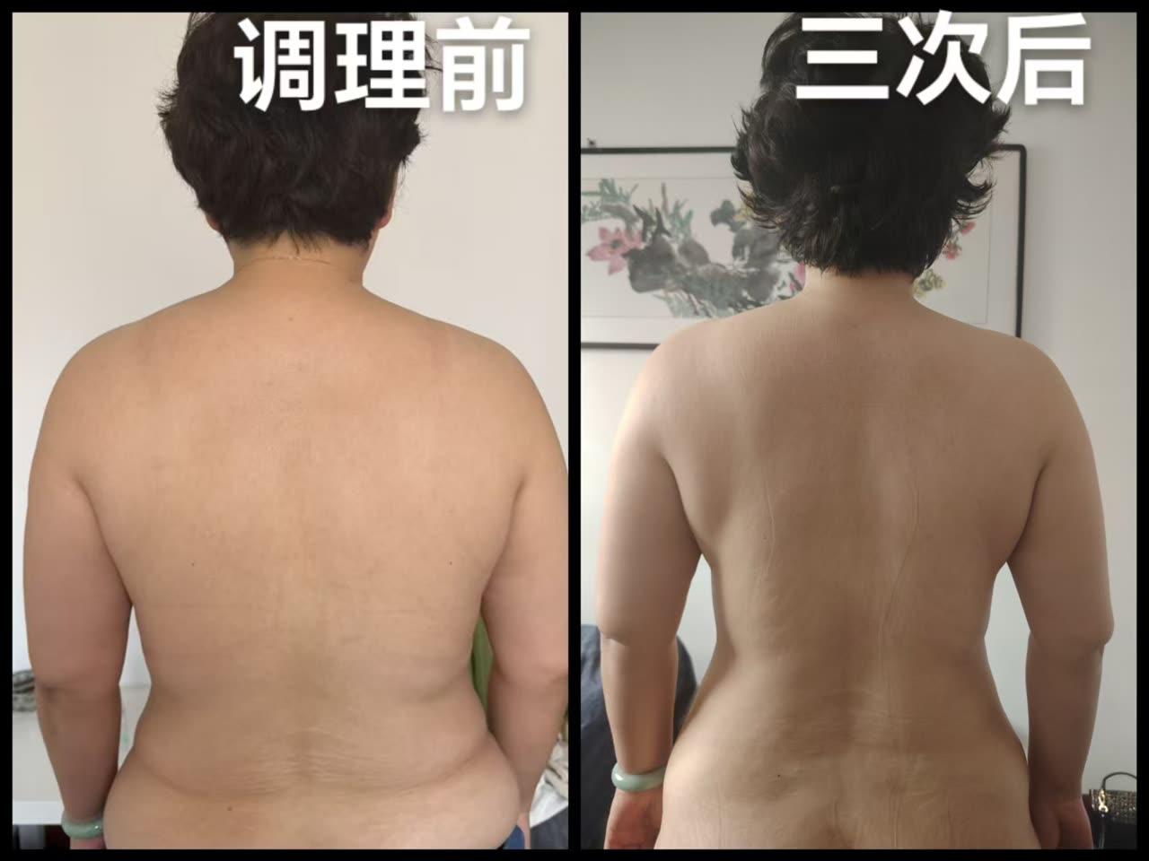 SKYE client's back before treatment and after three sessions