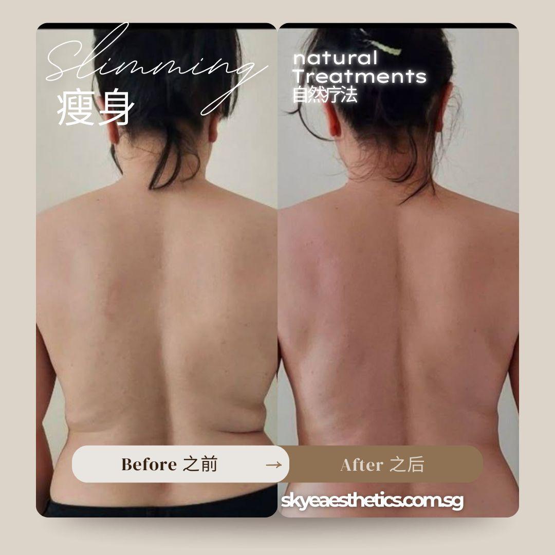 Before and after — Back And Shoulder Care 01 | SKYE Aesthetics