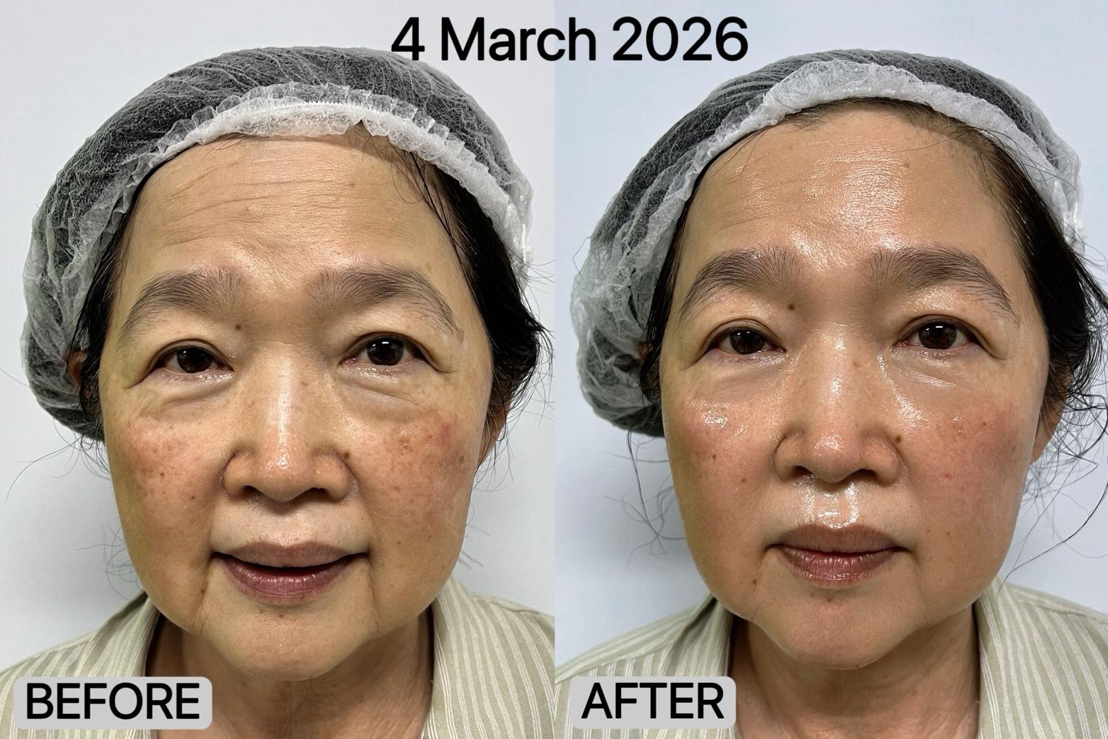 Before and after — Facial Lifting 01 | SKYE Aesthetics