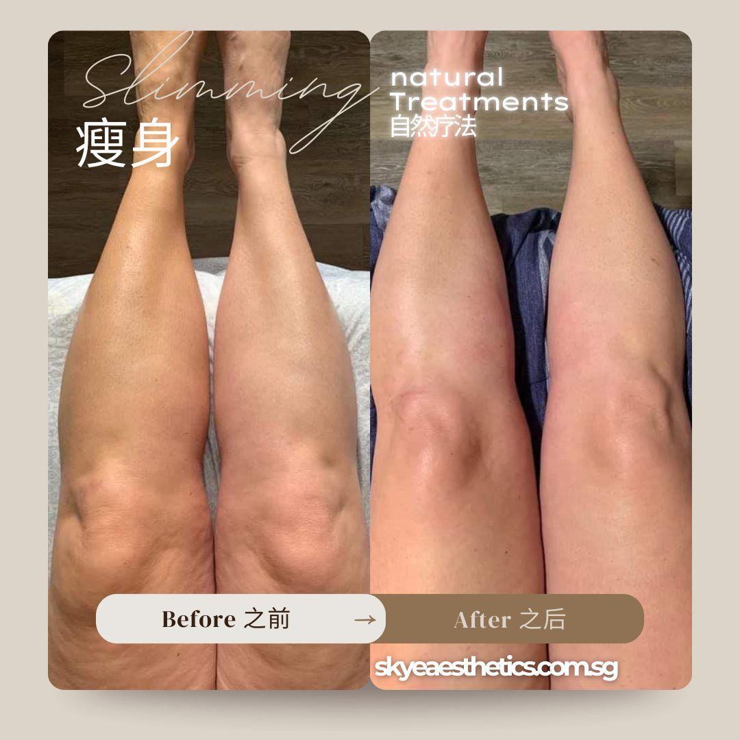 Before and after — Leg Care 01 | SKYE Aesthetics