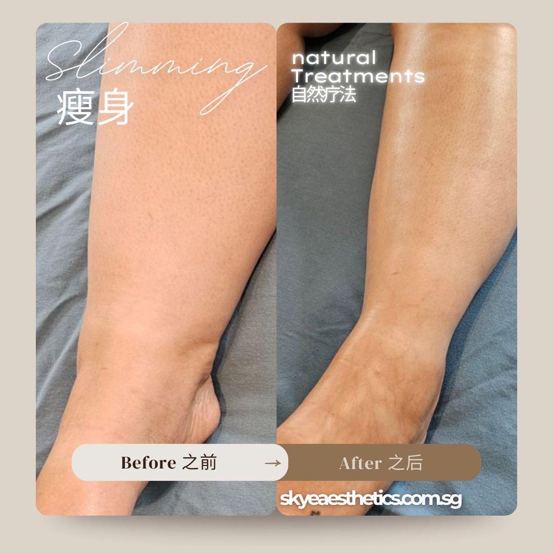 Before and after — Leg Care 02 | SKYE Aesthetics