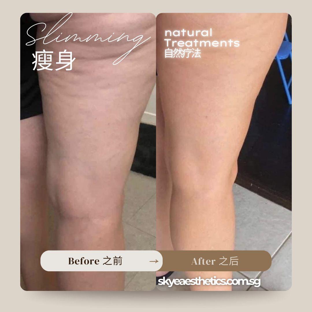 SKYE Aesthetics — Legs Contouring 03
